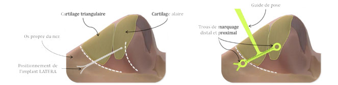 Mise en place Implant Latéra